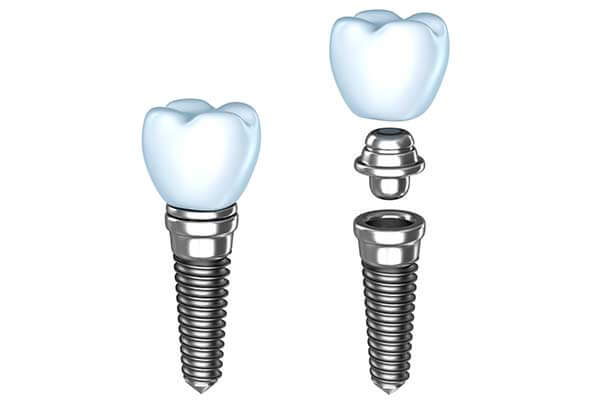 Dental Implants